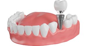 インプラントの図解イメージ