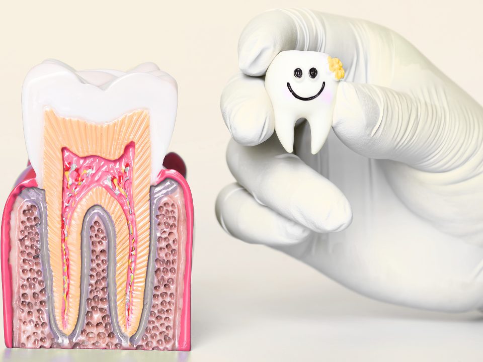 歯の神経や内部の模型
